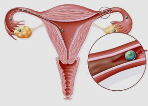 输卵管通液术过程步