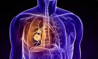 肺癌中期症状表现